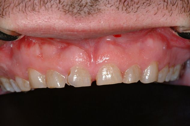 Crown Lengthening Functional Crown Lengthening of Worn Upper Teeth - Before