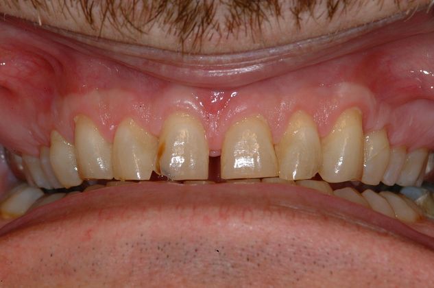 Crown Lengthening Functional Crown Lengthening of Worn Upper Teeth - After
