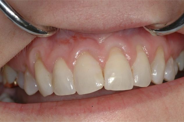 Soft Tissue Grafting Connective Tissue - All upper front - Before