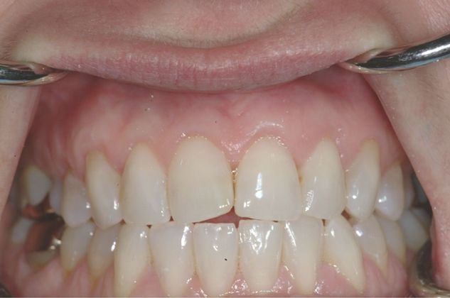 Soft Tissue Grafting Connective Tissue - All upper front - After