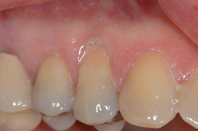 Soft Tissue Grafting Connective Tissue Graft Upper Front Tooth - Before