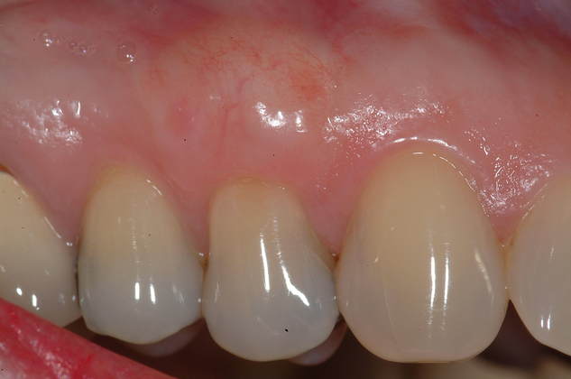 Soft Tissue Grafting Connective Tissue Graft Upper Front Tooth - After