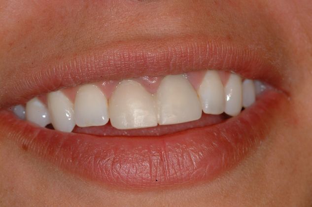 Dental Implants Upper Front Tooth - Before