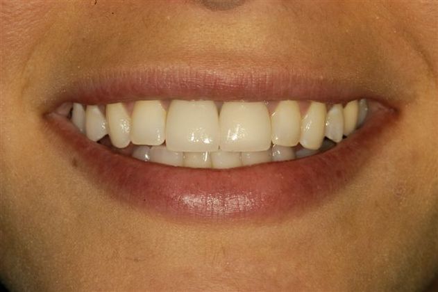 Dental Implants Upper Front Tooth - After