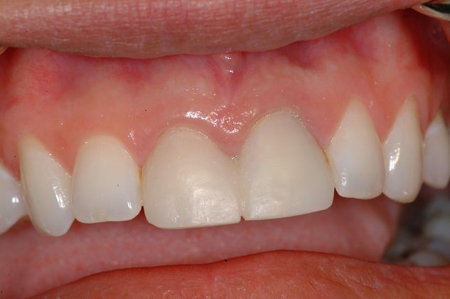 Dental Implants: Upper Front Tooth - Before