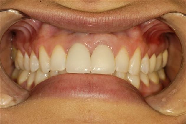 Dental Implants: Upper Front Tooth - After