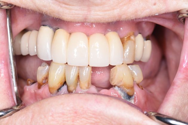 Dental Implants Total Tooth Replacement of Lower Jaw - Before