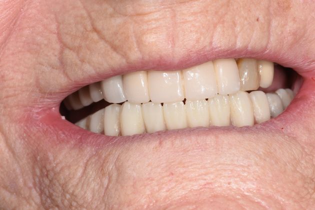 Dental Implants Total Tooth Replacement of Lower Jaw - After