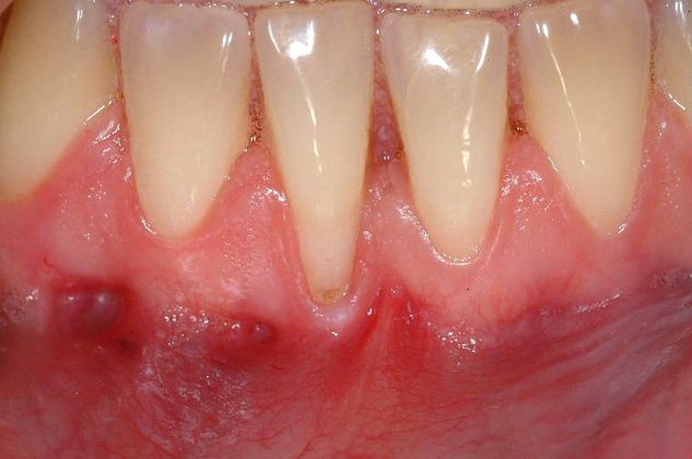 Soft Tissue Grafting Connective Tissue Graft Lower Front Tooth - Before