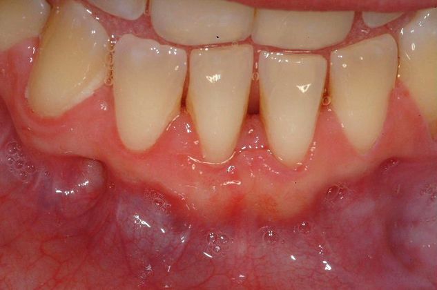 Soft Tissue Grafting Connective Tissue Graft Lower Front Tooth - After