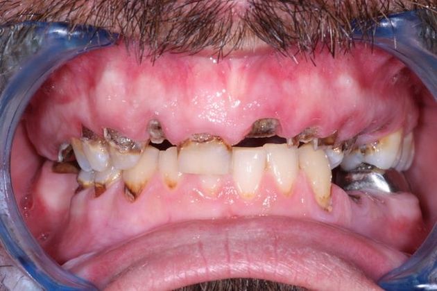 Dental Implants Total Tooth Replacement of Upper Jaw - Before