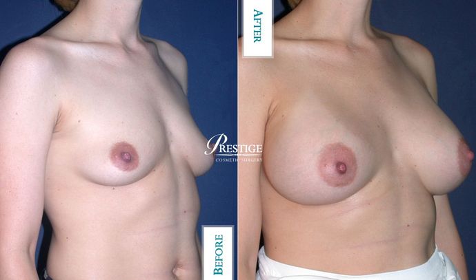 Breast Augmentation Case 13