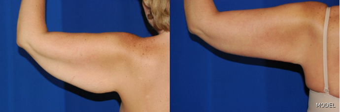 Arm Contouring / Lift Cases