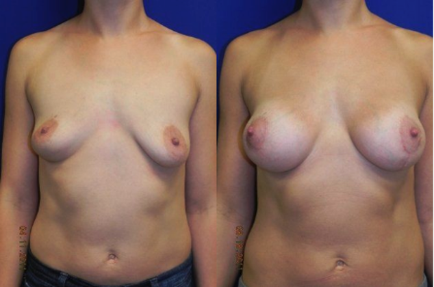 Breast Asymmetry / Deformity Cases