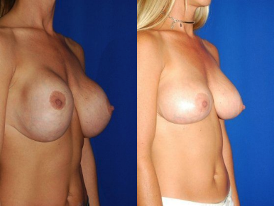 Breast Implant Problems / Correction / Revision Cases