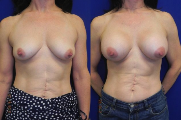 Breast Lift / Mastopexy Cases