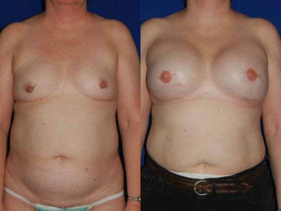 Breast Reconstruction / Mastectomy Cases
