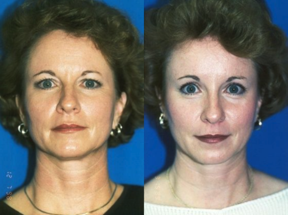 Facial Eyelid Surgery / Blepharoplasty Cases
