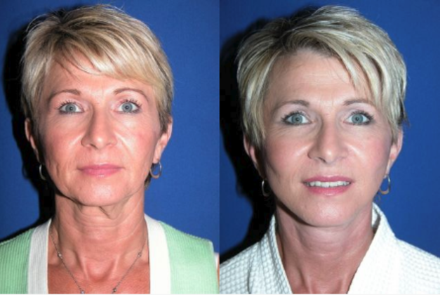 Facial Facelift / Necklift Cases