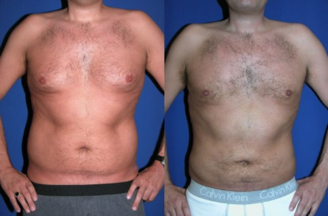 Male Body Contouring Cases