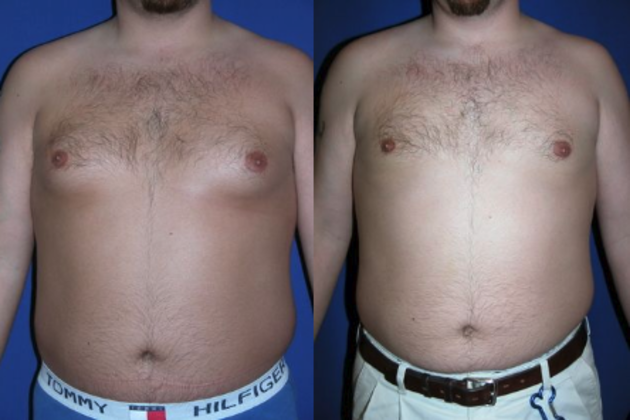 Male Breast / Gynecomastia Cases