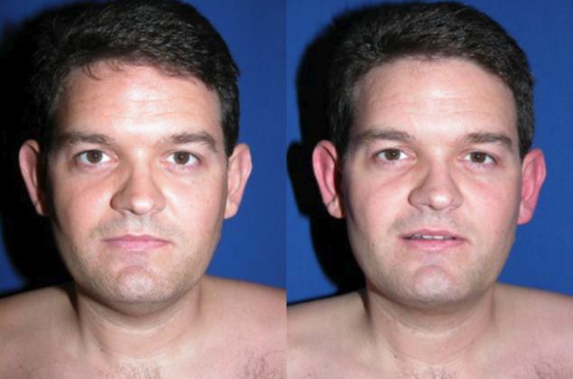 Male Face Cases