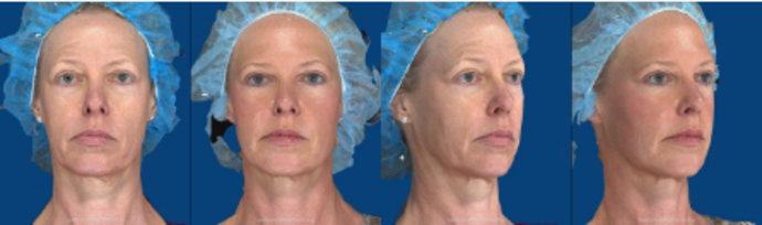 Injectables Minimally-Invasive / Fillers Cases