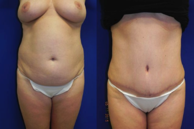 Body Tummy Tuck / Abdominoplasty Cases