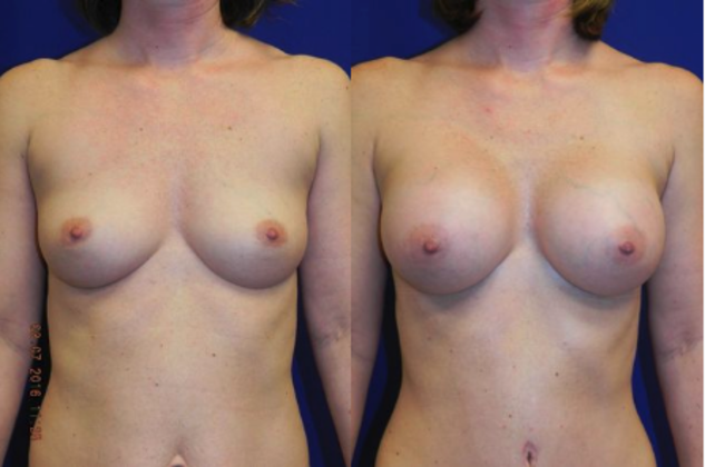 Body Mommy Make-Over Cases