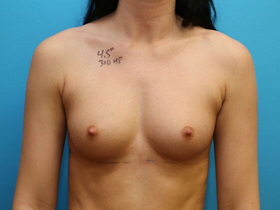 Breast Augmentation: Case 13 - Before