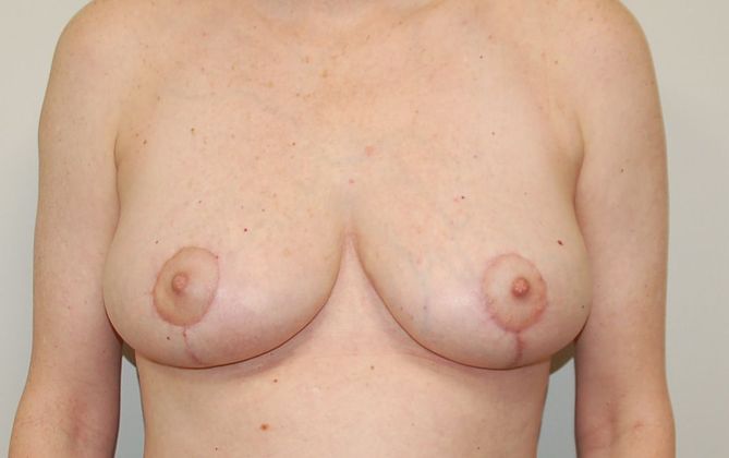 Breast Reduction: Case 54 - After