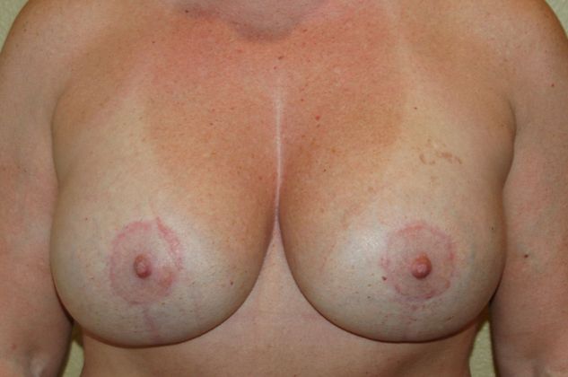 Breast Revision: Case 81 - Before