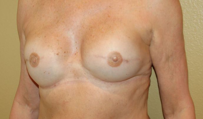 Breast Reconstruction: Case 62 - After