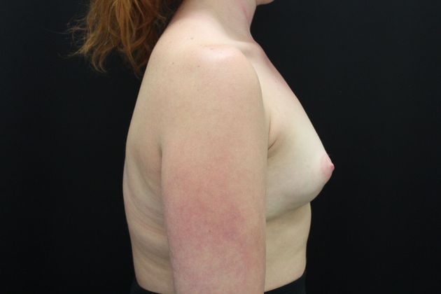 Breast Augmentation: Case 59 - Before