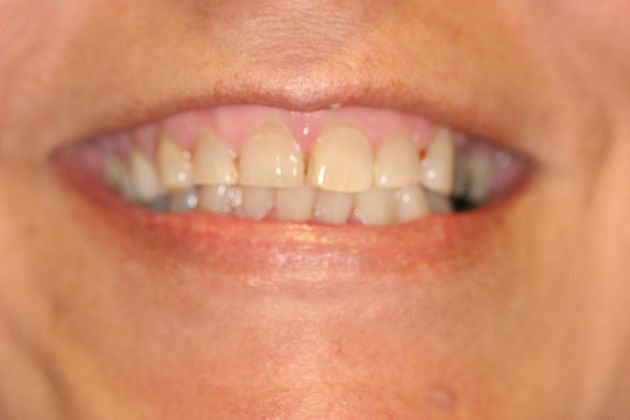Veneers Case 2 - Before