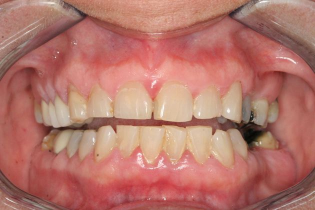 Veneers: Case 2 - Before
