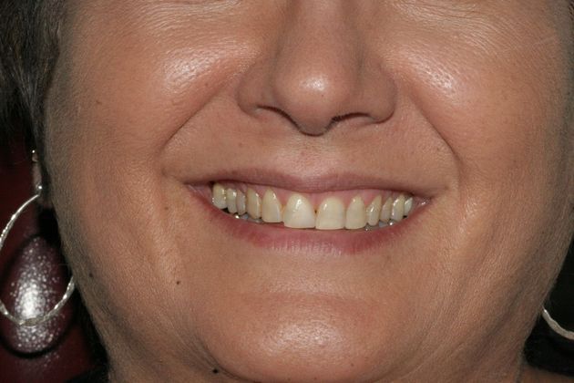 Veneers Case 5 - Before