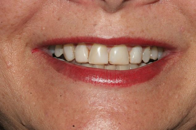 Veneers Case 6 - Before