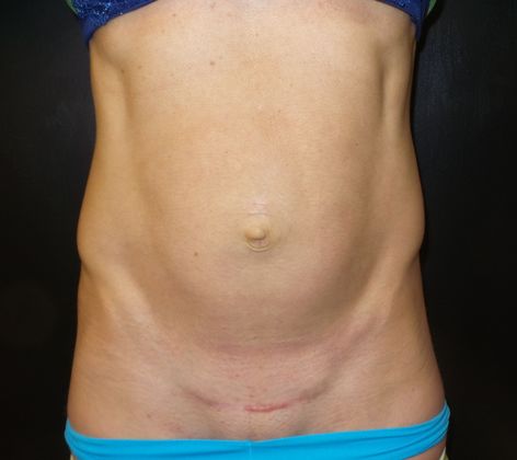 Tummy Tuck: Case 29 - Before