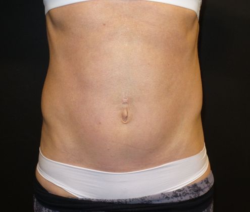 Tummy Tuck: Case 29 - After