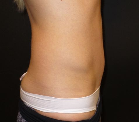 Tummy Tuck: Case 29 - After