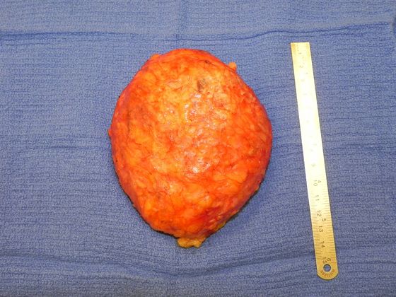 Breast Ruptured Gel Implants: Case 2 (19551) - Left capsule containing implant