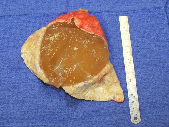 Breast Ruptured Gel Implants: Case 2 (19551) - Left capsule opened, showing implant material