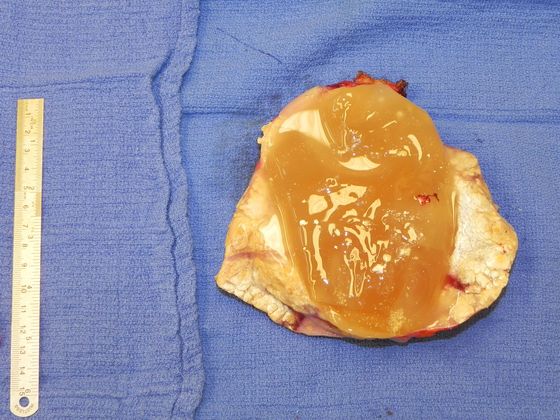 Breast Ruptured Gel Implants: Case 2 (19551) - Right capsule opened, showing implant material