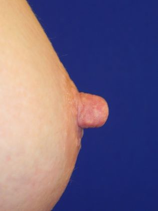 Breast Nipple & Areola  Case 5 (19391) - Before