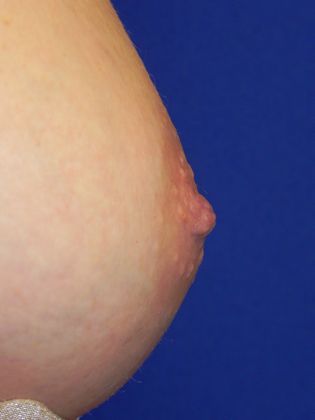 Breast Nipple & Areola  Case 5 (19391) - After
