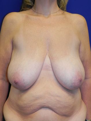 Breast Reduction Case 23 (19909) - Before