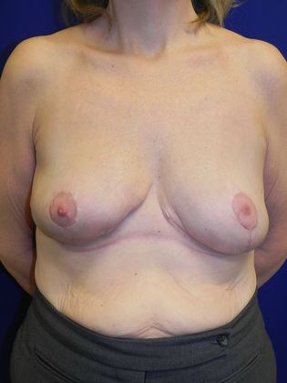 Breast Reduction Case 23 (19909) - After