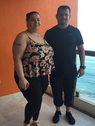 Gastric Sleeve Case 1 - Before