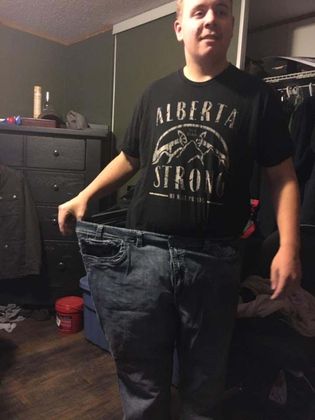 Gastric Sleeve Case 7 - After